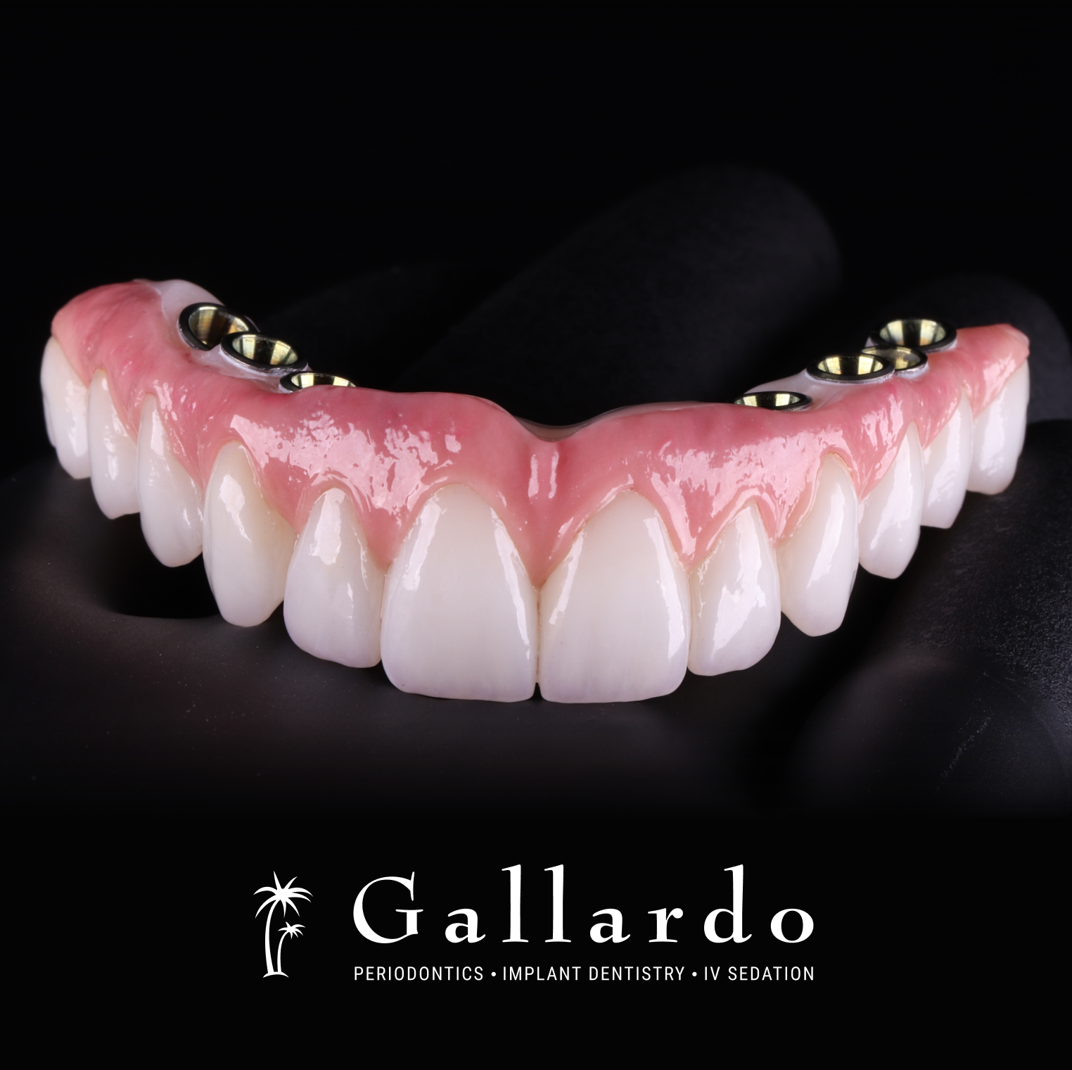 Hybrid Implant Bridge