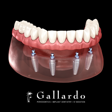 Zirconia Implant Bridge