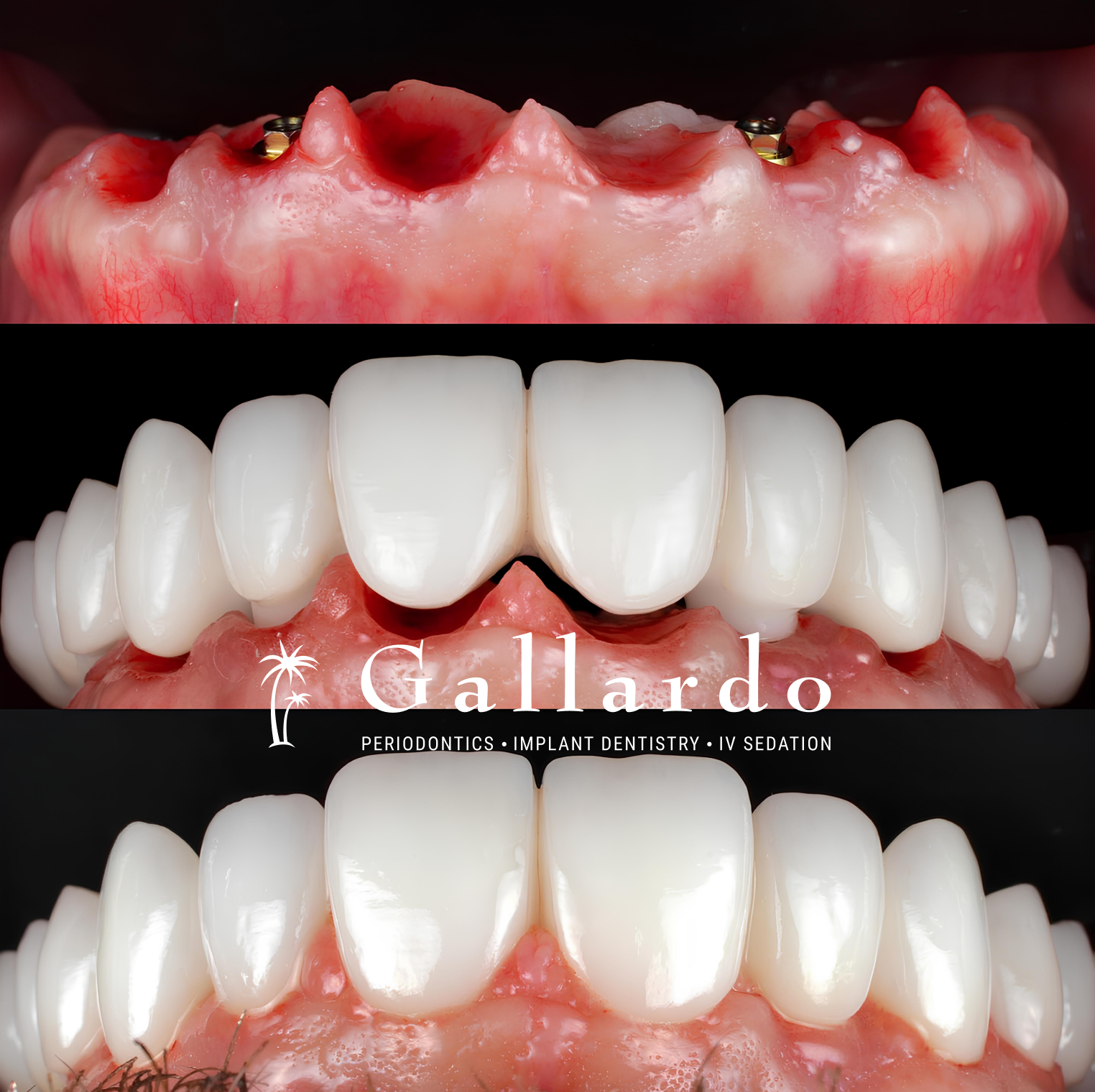 Porcelain Implant Bridge